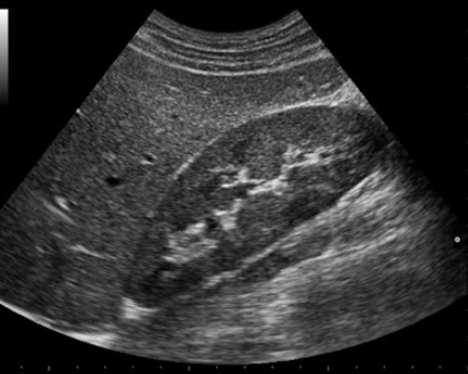 Ecografía Abdominal